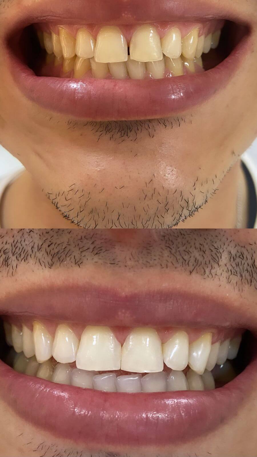 Antes e depois de fechamento de espaço entre dentes